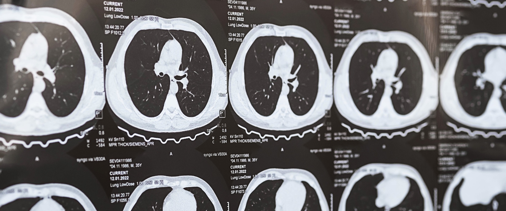 Low Dose Lung Cancer Scan
