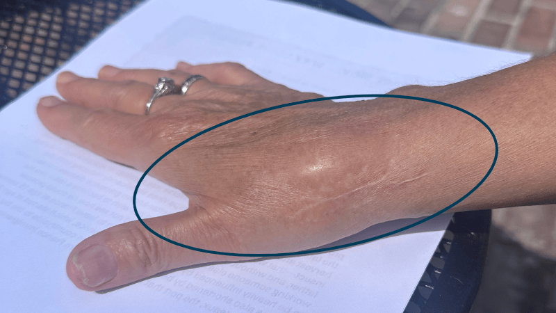 A photo of a wrist with a circle indicating where swelling has decreased following treatment.