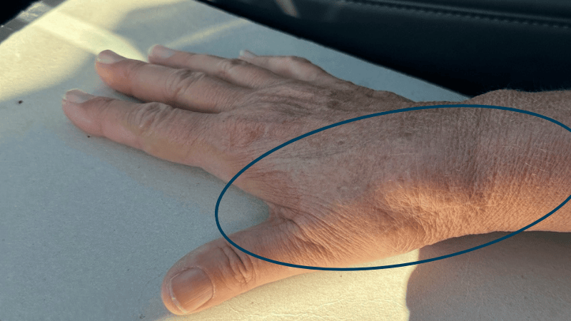 A photo of a wrist with a circle indicating where swelling had occurred.